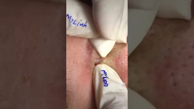 #асмр #прыщи #acne #acnetreatment #asmracne #давкапрыщей