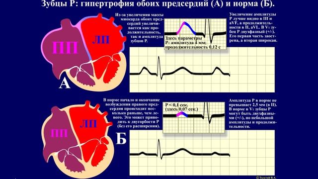 Тема 23.1. ЭКГ при гипертрофии камер сердца. смотреть онлайн