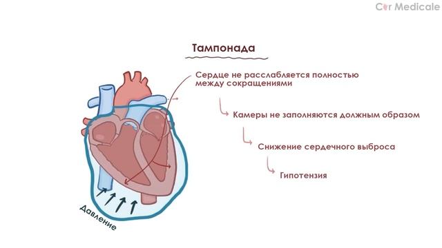 Тампонада сердца смотреть онлайн