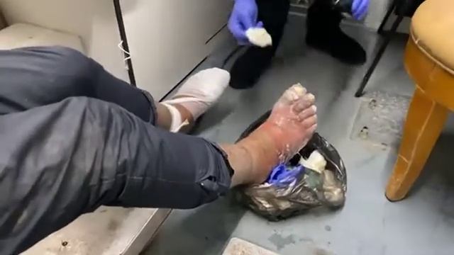 Молодой парень гниёт заживо. Жизнь Бездомного человека на улице. Последствия смотреть онлайн