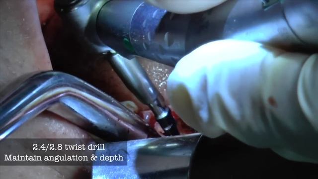 *NEW Immediate Molar Implant 5.5 implant WP NobelActive смотреть онлайн