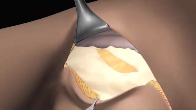 The Axillary Vein: 3D Animation of Axillary Lymph Node Dissection Procedure Part - 3 смотреть онлайн