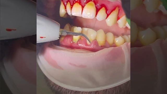 Зубные камни ??? смотреть онлайн