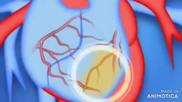Сердечно сосудистые заболевания(инфаркт и инсульт) смотреть онлайн