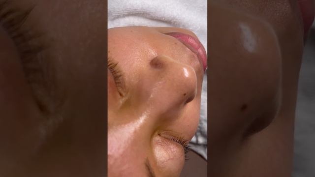 Blackheads, my favorite! These are caused when your pores are clogged with oil and dead skin cells. смотреть онлайн