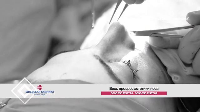 ринопластика 2019 смотреть онлайн