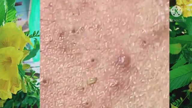 Satisfying and Relaxation | Удаление черных точек в ссуде Sapa, удовлетворяющей и расслабляющей смотреть онлайн