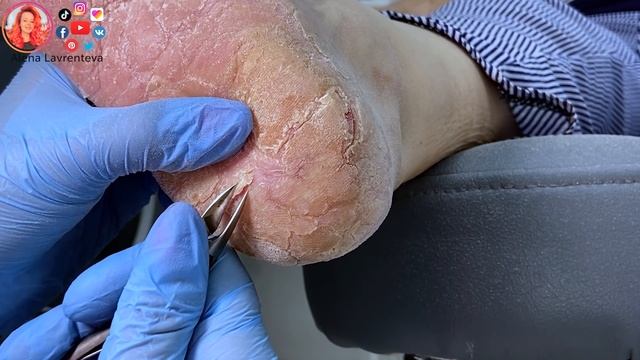 Трещины на пятках / Потрескалась кожа на ногах смотреть онлайн