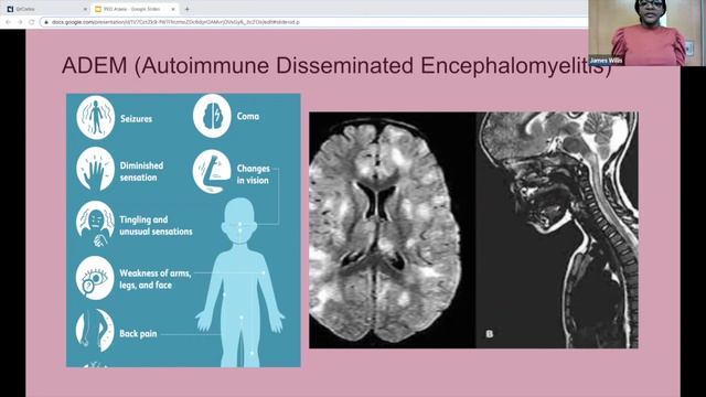 Dr. Beabrun - "Pediatric Ataxia and Myelopathies" смотреть онлайн