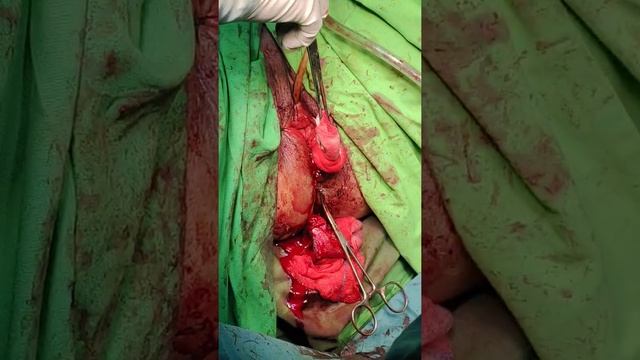 Penjahitan Ruptur Perineum Gr IV Lama part 2 смотреть онлайн