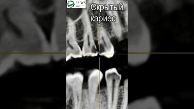 Компьютерная Томография и её преимущества в стоматологии | Стоматология СПБ | 33 ЗУБ смотреть онлайн