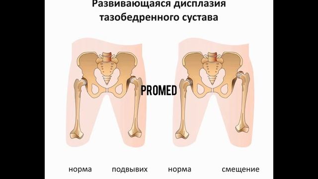 Сан сүйегінің ұршық басының шығуы | Дисплазия дегеніміз не?