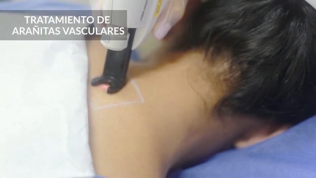 Elimina Venas Vasculares con HARMONY XL смотреть онлайн