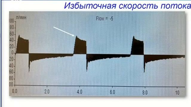 Асинхронии при ИВЛ Корякин А.Г. смотреть онлайн