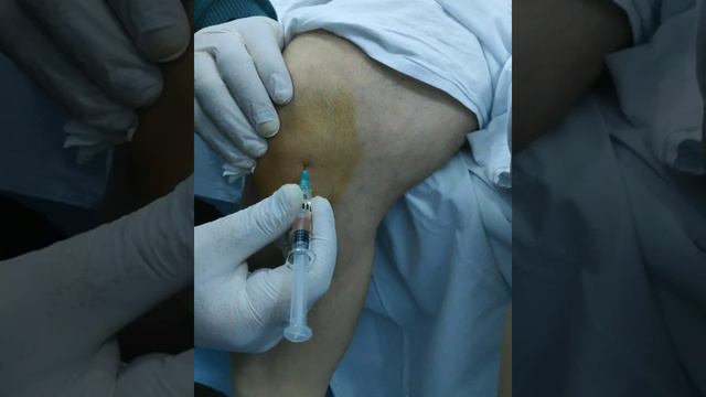 Diz Oynağı Daxilinə Hialuron Turşusu İnyeksiyası смотреть онлайн