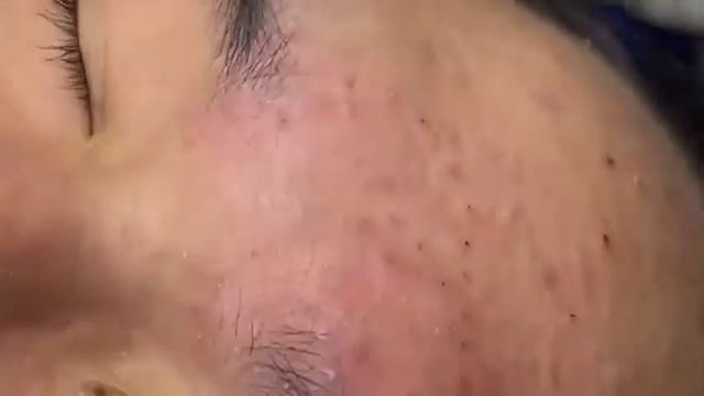 Давим прыщи - чёрные точки. Залипательное видео. Removes Acne. Видео с прыщами 2021