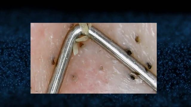 ЧЕРНЫЕ ТОЧКИ/BLACKHEAD Removal