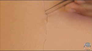 Внутрикожный шов по Шассеньяку и Холстеду. Техника наложения косметического хирургического шва