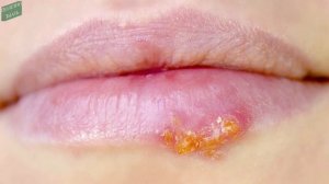 Простуда на губе. ?3 способа быстро ВЫЛЕЧИТЬ ГЕРПЕС на губах