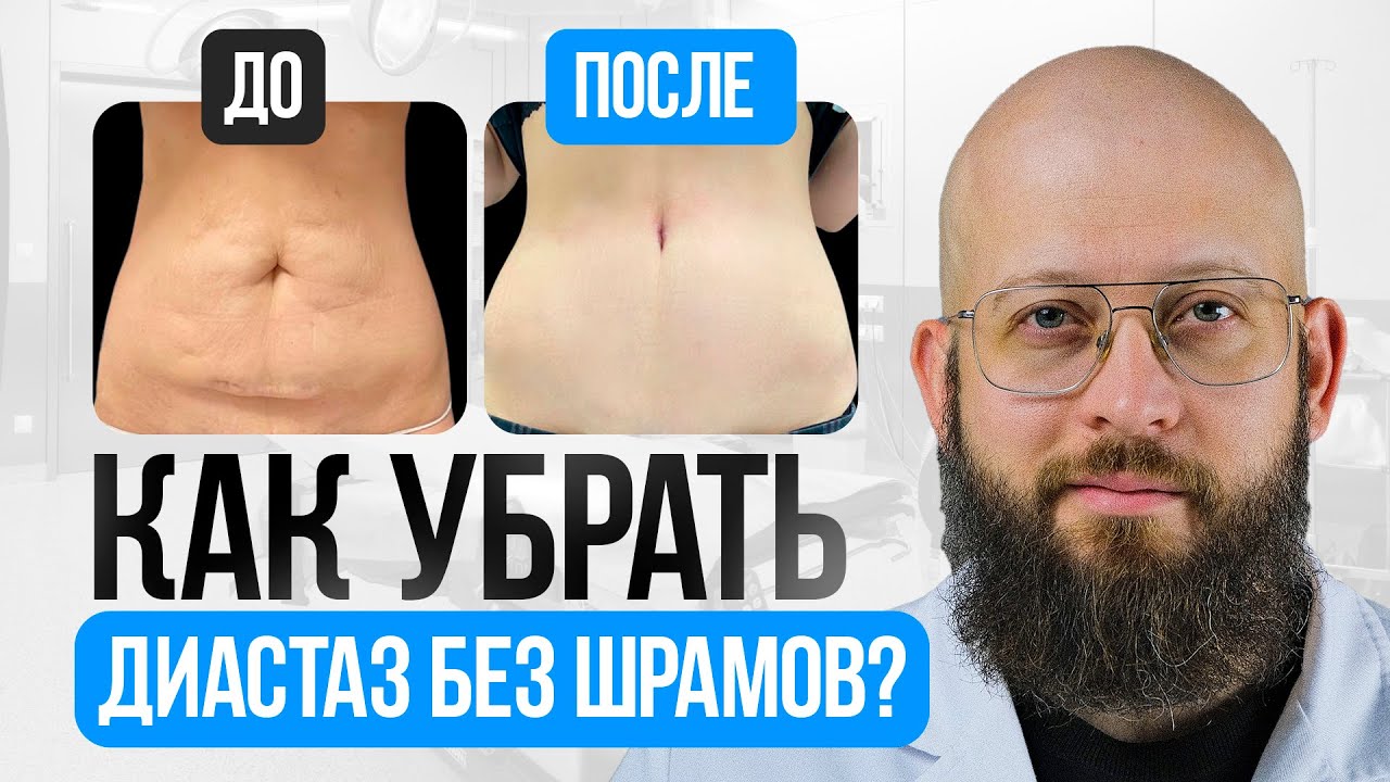 Про Метод Диастаза без Шрамов смотреть онлайн