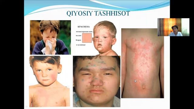 Qizamiq Va Qizilcha Kasaliklari Haqida Ma'ruza.