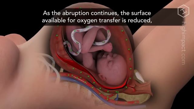 Placental Abruption смотреть онлайн