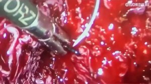 Лапароскопическая миомэктомия. Узел 9см на задней стенке матки