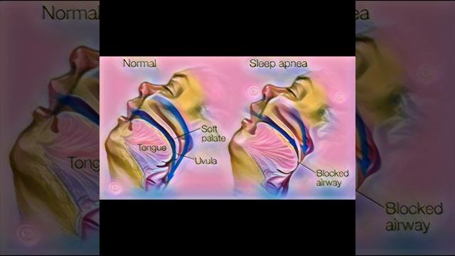 Death of Bappi Da।Obstructive Sleep Apnea смотреть онлайн