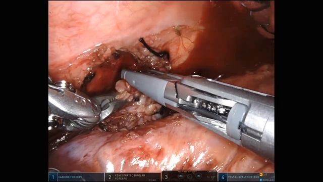 Trans-thoracic Robotic Retrocrural Metastatic Lymph Node Resection смотреть онлайн
