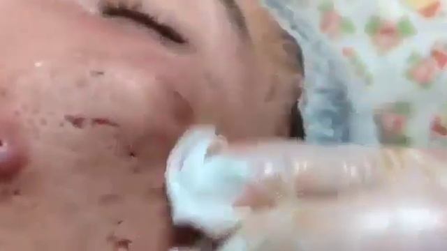 НОВОЕ ВИДЕО 2022 Прыщи давить залипательные смотреть онлайн