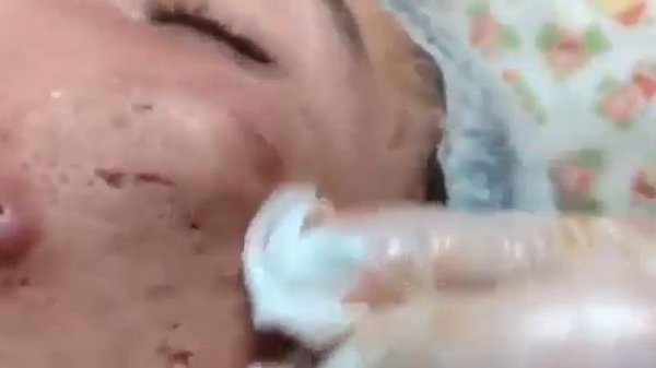 НОВОЕ ВИДЕО 2022  Прыщи давить залипательные