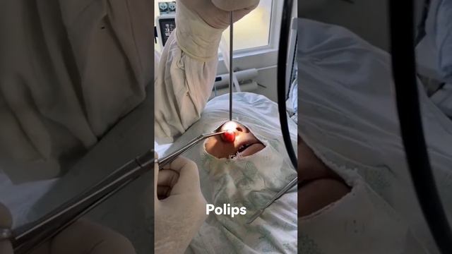 Полип полости носа смотреть онлайн