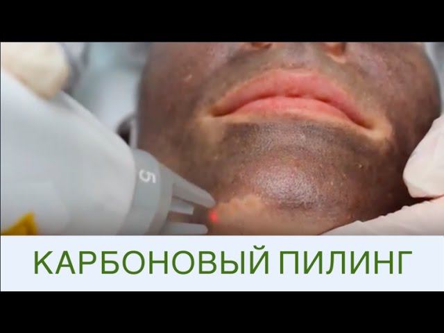 Лазерный карбоновый пилинг - эффективная чистка лица! смотреть онлайн