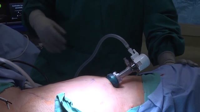 Winship Surgeons Pioneer Minimally Invasive Groin Dissection смотреть онлайн