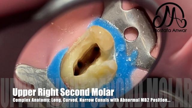 Abnormal MB2 Canal Location in Maxillary Second Molar | Root Canal Treatment | Narrow Curved Canals смотреть онлайн