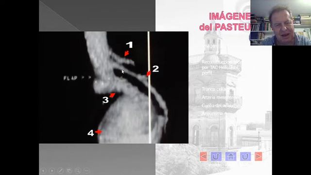 Enfermedades de la aorta abdominal смотреть онлайн
