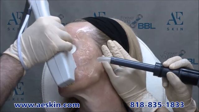 Forever Young BBL IPL Photofacial demonstration 32 - A E Skin - Encino, CA - 818-835-1833 смотреть онлайн