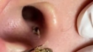 Прыщи / Огромные прыщи / Релакс с акне / Выдавливание прыщей / Черная точка  #Прыщи