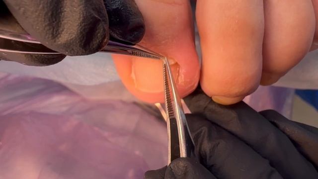 Вросший ноготь у ребенка/ Причины врастания ногтей /Этот ролик ответит на все ваши вопросы #вросший