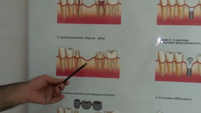 Что лучше имплант или мостовидный протез? смотреть онлайн
