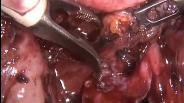 Эндометриоз 2. Вторая часть. смотреть онлайн