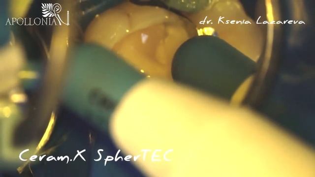 Восстановление правильной анатомии жевательной поверхности и профиля проксимального контакта