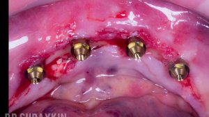 Имплантация зубов , протезирование на имплантах , протез на имплантах , коронки на имплант, виниры