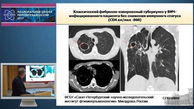 П.В. Гаврилов - Рентгенологическая диагностика туберкулеза у ВИЧ-инфицированных смотреть онлайн
