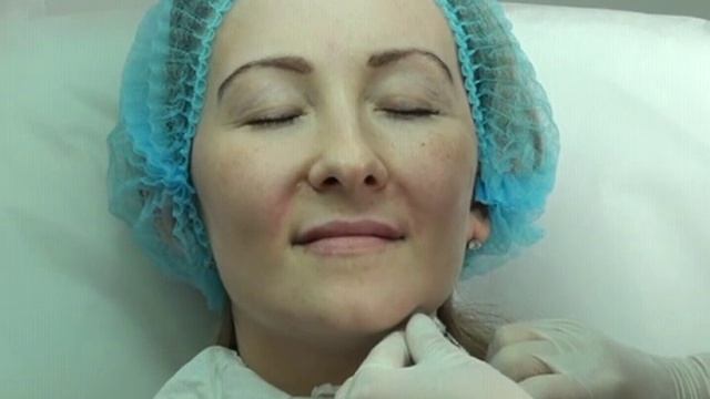 Контурная пластика Princess® Filler часть 3