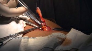 Полостная аппендэктомия без ассистента