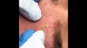 НОВОЕ ВИДЕО 2022  Прыщи давить залипательно ЧЕРНЫЕ ТОЧКИ