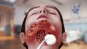 ASMR Remove Necrotic Head & Worm Infected | Deep Cleaning Animation