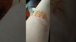 Снимаем швы спустя 10 дней
