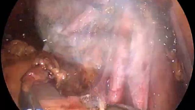Single port laparoscopic pelvic lymph node dissection using EnSeal смотреть онлайн